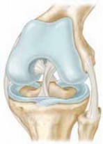 Illustration 23 for Microfracture Chondroplasty: How Tiny Holes Are Made to Fix Cartilage