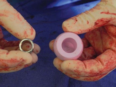 Illustration 54 for Unlock better THA: The technique of short stem for less invasiveness