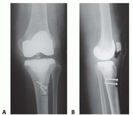 Illustration 15 for Patella Tendon Rupture Reconstruction in Revision TKA