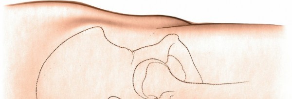 Illustration 129 for Unlocking Every Aspect of the Hip's Surgical Approaches