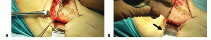 Illustration 14 for High Tibial Osteotomy: Realignment for Lasting Knee Pain Relief