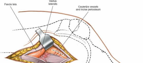 Illustration 228 for Mastering Knee Approaches: Spotlight on Superficial Medial Ligament