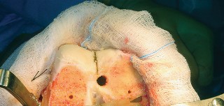 Illustration 40 for Mastering TKA: Essential Methods of Rotational Alignment