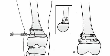 Illustration 17 for Master Pediatric Femoral Shaft & Knee Fractures: Interactive Module