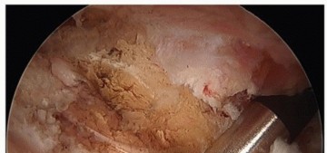 Illustration 12 for Hip Pain Relief: Arthroscopy for Nonstructural Pathology