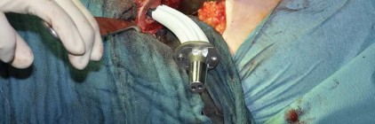 Illustration 61 for Collum Femoris Preserving: Achieve Better Primary Hip Outcomes