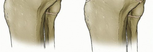 Illustration 2 for Treating Tibial Spine Fractures: Arthroscopy or Open Reduction?