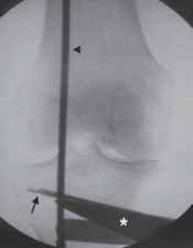 Illustration 33 for Guide Pin Assembly: Key to Flawless Upper Tibial Osteotomy