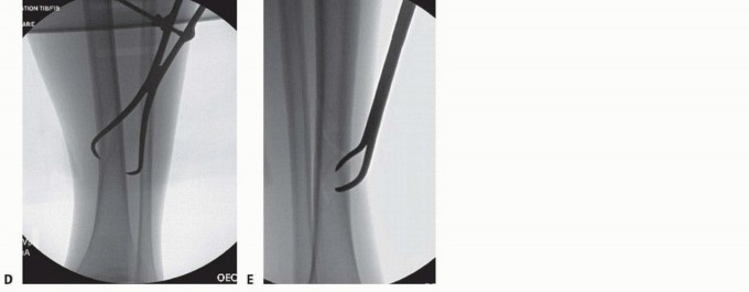 Illustration 30 for Advanced Nailing of the Mature Tibia: Overcoming Complexities