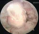 Illustration 24 for Cruciate Ligament Repair: Definitive Guide to Treatment & Recovery