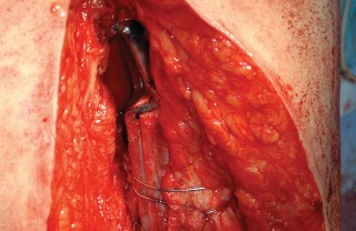 Illustration 98 for Femoral Stem Revision: Posterior Approach for Better Outcomes