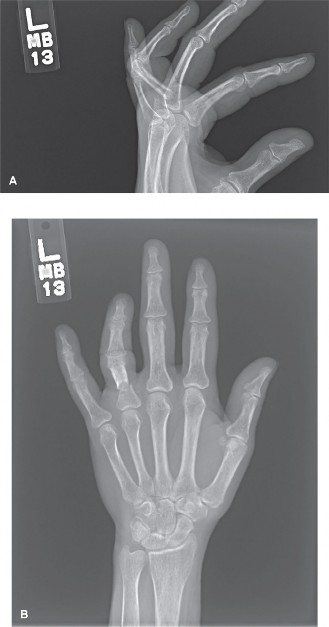 Ring Finger Fracture: Reduction & Percutaneous Pin Treatment Insights