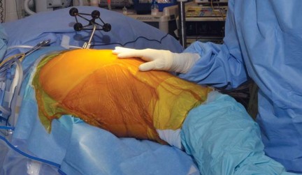 Illustration 10 for Robotics in Total Hip Arthroplasty: A New Era of Precision