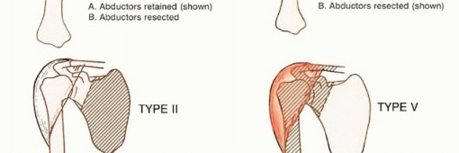 Illustration 7 for Limb-Sparing Resections Around the Shoulder: Optimizing Outcomes