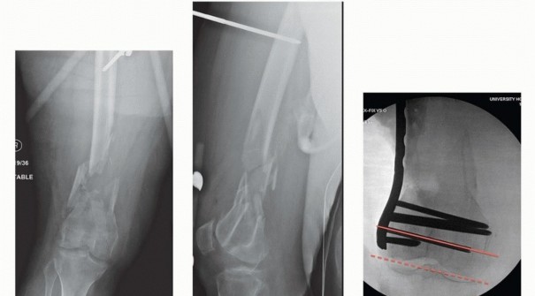 Illustration 25 for Repairing Distal Femur Fractures: Open Reduction & Internal Fixation