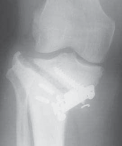 Illustration 47 for Guide Pin Assembly: Key to Flawless Upper Tibial Osteotomy