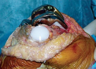 Illustration 33 for The Principles of Revision TKR: Avoid Pitfalls, Ensure Success