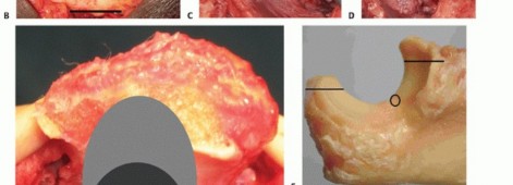 Illustration 25 for Distal Humeral Fractures: When Is Elbow Replacement the Best Option?