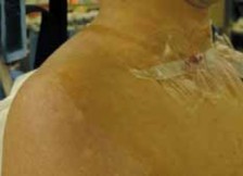 Illustration 6 for Capsular Releases for Loss of Motion: Restore Your Shoulder