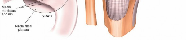 Illustration 16 for Mastering Knee Arthroscopy Approaches: Safely Withdraw the Arthroscope