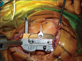Illustration 10 for Minimal Incision Total Knee: Experience Faster Healing