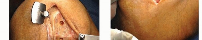 صورة طبية: استبدال مفصل الركبة الجزئي: حل متقدم لآلام الركبة المستمرة مع الأستاذ الدكتور محمد هطيف