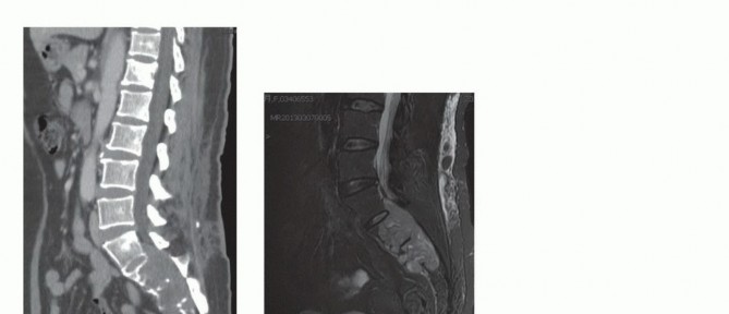 Illustration 49 for Sacral Tumor Surgery: Safeguarding Bowel & Bladder Control