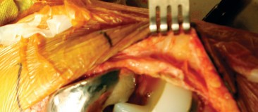 Illustration 38 for Precision Soft Tissue Balancing in Revision: Avoid TKA Pitfalls