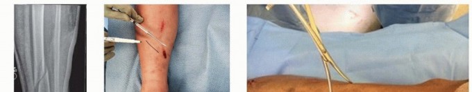 Illustration 28 for Advanced Nailing of the Mature Tibia: Overcoming Complexities