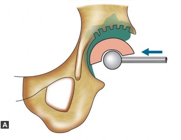 Illustration 27 for Optimizing Acetabular Component Cementation for Superior Outcomes