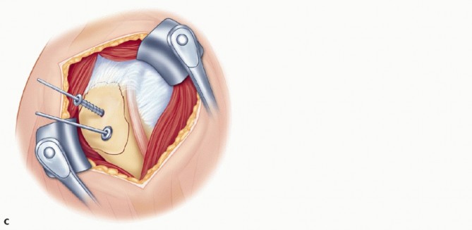 Illustration 9 for Optimizing Fixation of Proximal Humerus Fractures: A Guide