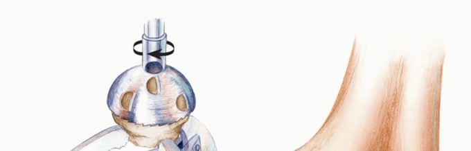 Illustration 6 for Optimizing Revision Femoral Component with Distal Femoral Bone Loss