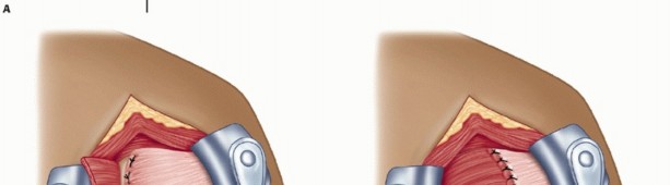 Illustration 29 for Finally Treat Recurrent Posterior Instability of the Shoulder