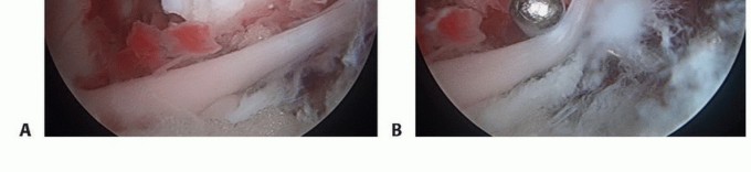 Illustration 6 for Treating Tibial Spine Fractures: Arthroscopy or Open Reduction?