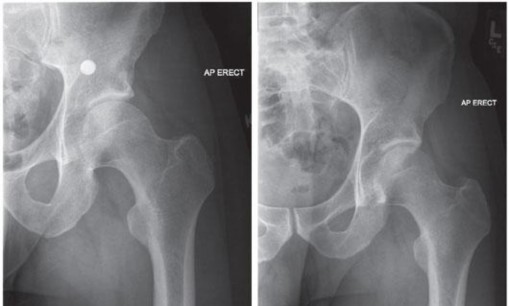 Illustration 13 for Precision Hip Arthroscopy: Unlock Access to the Peripheral Compartment