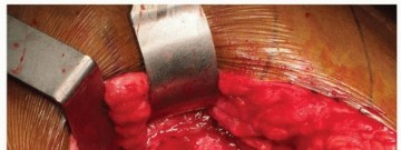 Illustration 12 for Uncemented Acetabular Revision: Optimizing Hemispherical Cup Use