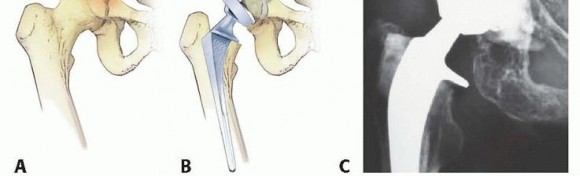 Illustration 5 for Regain Mobility: Total Hip Arthroplasty for Malignant Lesions