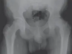 صورة توضيحية لـ جراحة تصحيح انزلاق مشاش رأس الفخذ الحاد: استعادة حركة الورك الطبيعية