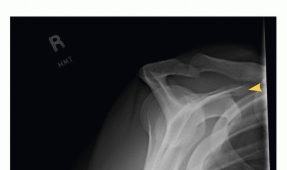 Illustration 6 for Is Your Dorsal Scapular Nerve Causing Snapping Scapula Pain?