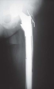 Illustration 77 for S-ROM: Inside the Technique of Modular Implant Design