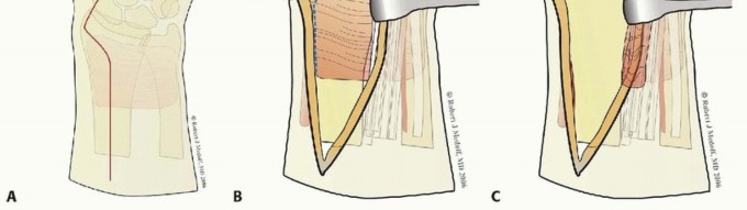Illustration 20 for Fragment-Specific Fixation: Restore Carpal Facet Horizon