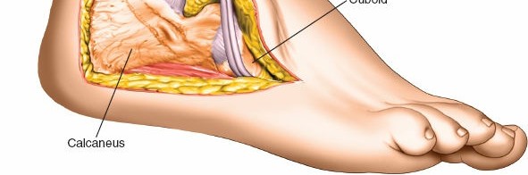 Illustration 16 for Mastering the Lateral Approach to the Posterior Talocalcaneal Joint