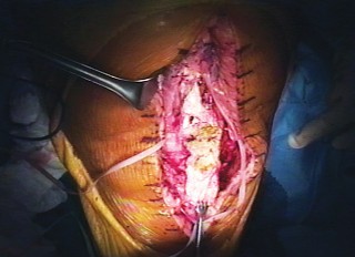 Illustration 9 for Extensor Reconstruction in Total Knee Arthroplasty: Essential Strategies