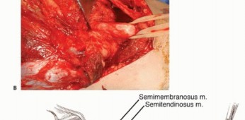 Illustration 19 for Posterior Thigh Resection: Rethinking Outcomes & Limb Sparing