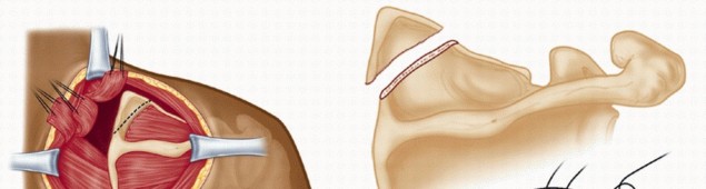 Illustration 16 for Solving Snapping Scapula: Is resection of the superomedial your option?