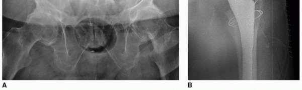 Illustration 6 for Sliding Trochanteric Osteotomy: Modern Role & Refined Techniques