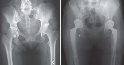 Illustration 18 for Maximize Success: Preoperative planning in primary Hip Replacement