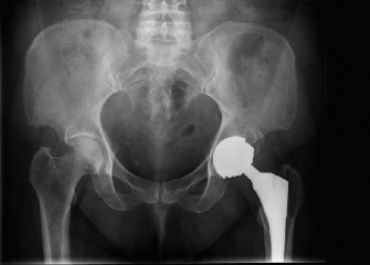 Reconstruction Cases MoM: Key Strategies for Complex Hip Issues