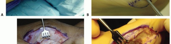 Illustration 19 for Restore Your Foot: Surgical Treatment for Hallux MP Joint Turf Toe