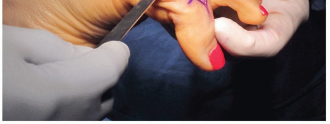 Illustration 29 for End Articular Cartilage Loss: Arthrosurface HemiCAP Resurfacing